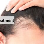 Hair Fall Treatment